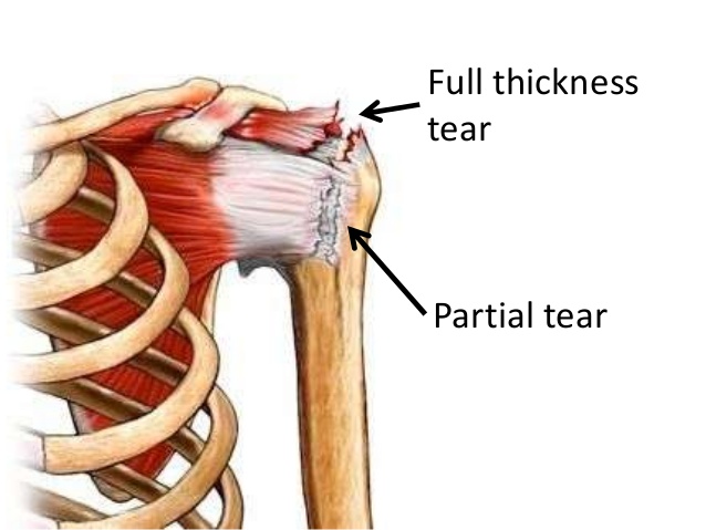 rotator-cuff-tears-ryderoadphysio